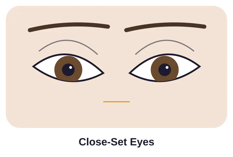 Illustration of close-set eyes