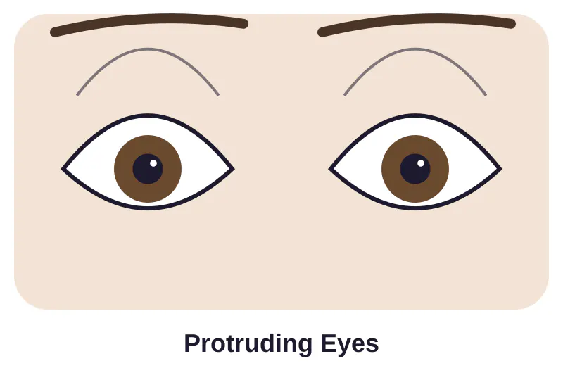 Illustration of protruding eyes