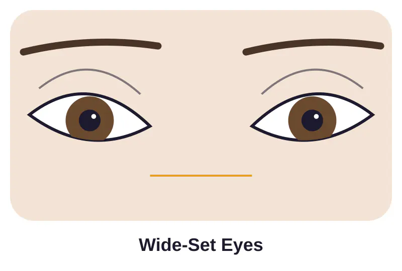 Illustration of wide-set eyes