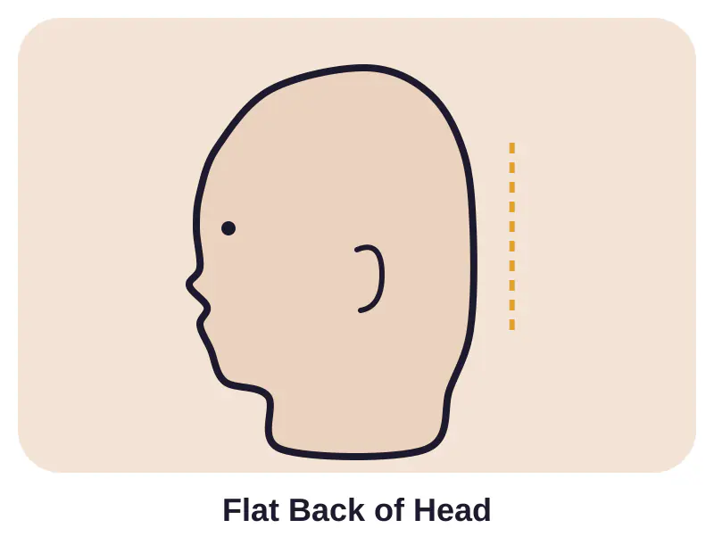 Illustration of flat back of head