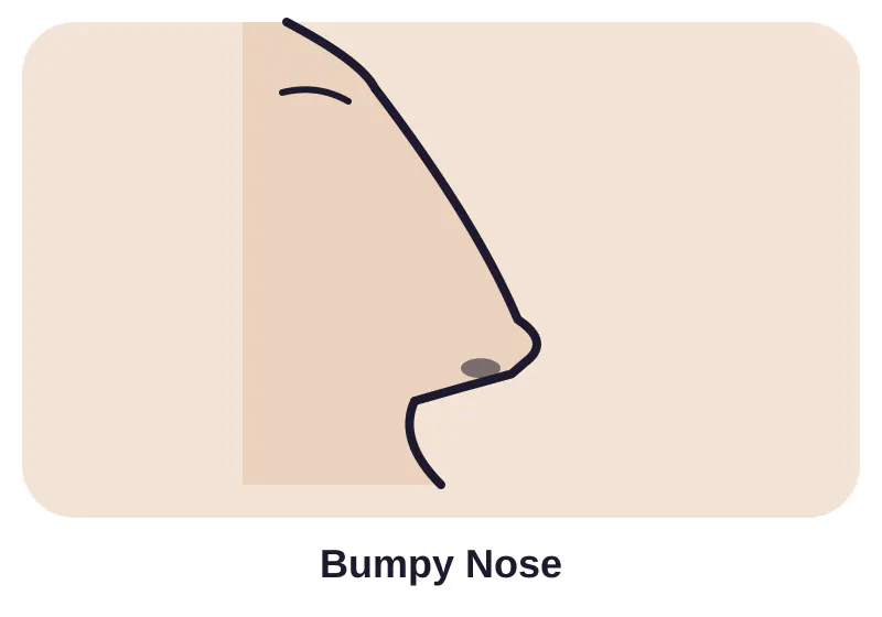 Illustration of bumpy nose